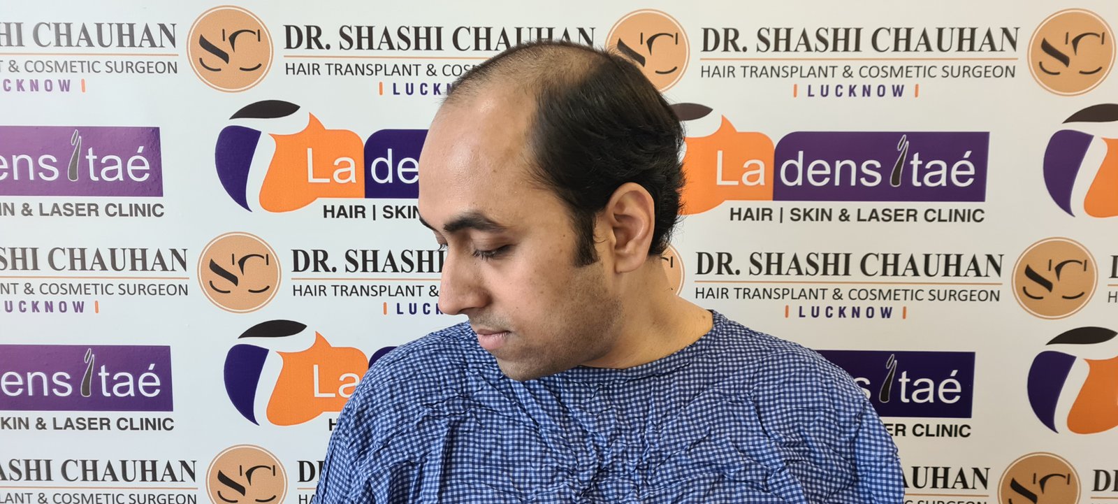 Utsav Aman Before Hair Transplant